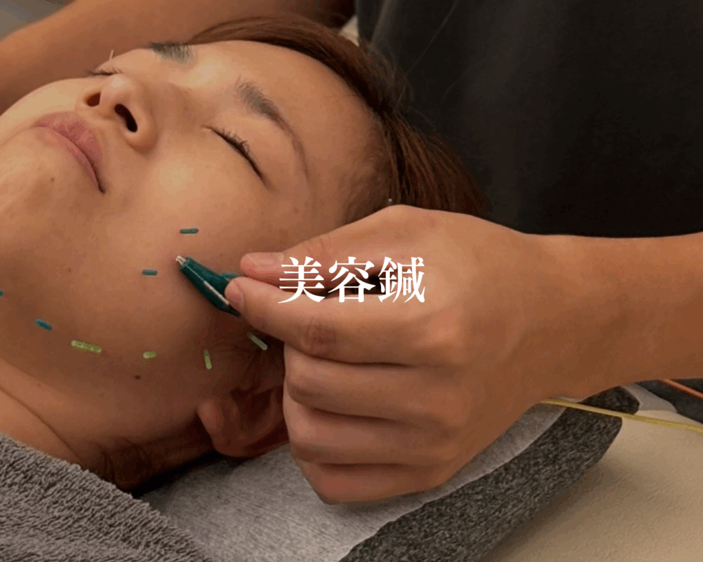 美容鍼