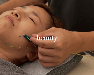 美容鍼をしている写真